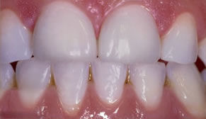 Cosmetic Dentistry After Photo