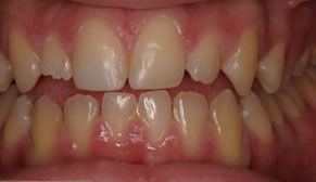 Dental Crowns Before Photo