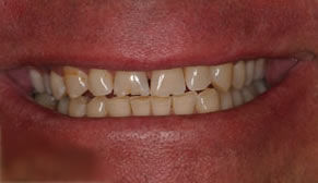 Dental Crowns Before Photo