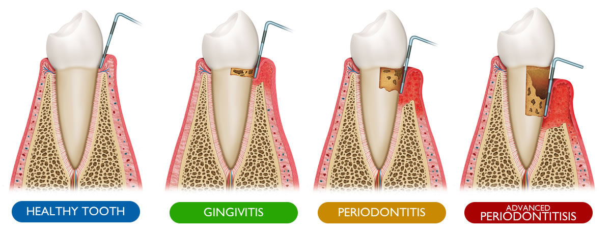 Gum Disease Stages - Healthy Tooth, Gingivitis, Periodontitis, Advanced Periodontitis