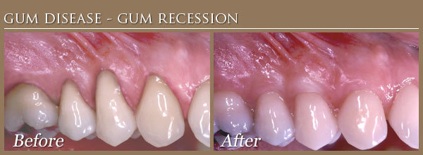 gum disease treatment before and after