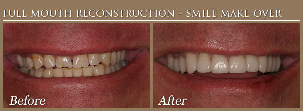 veneers Before and After