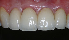 Anterior Implants After Photo