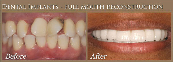 Dental Implants, full mouth reconstruction