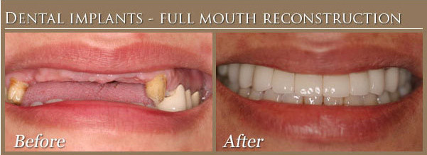 Full Mouth Dental Implants Before and After