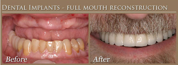 Complete mouth Dental Implants Before and After