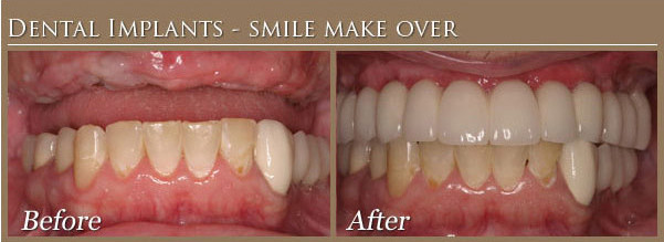 same day Dental Implants Before and After