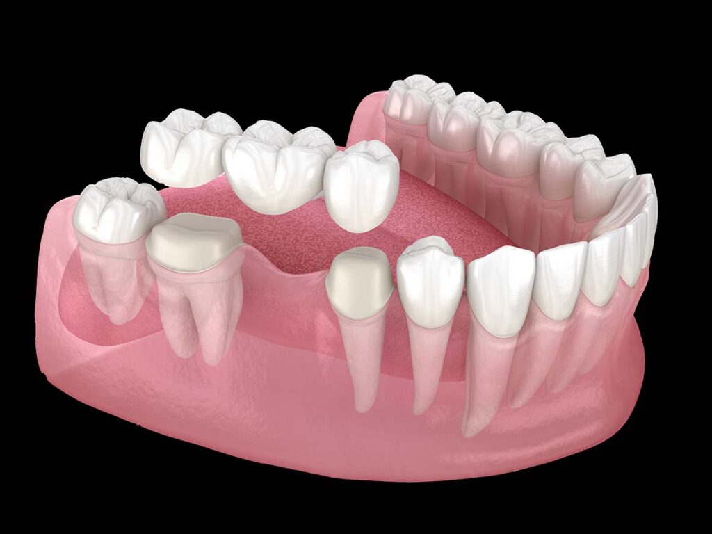 dental bridges
