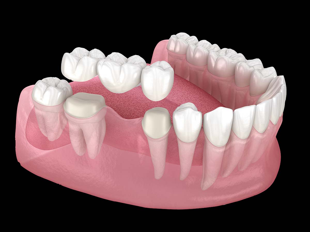 dental bridges