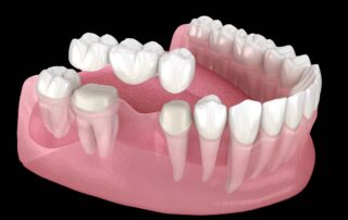 dental bridges