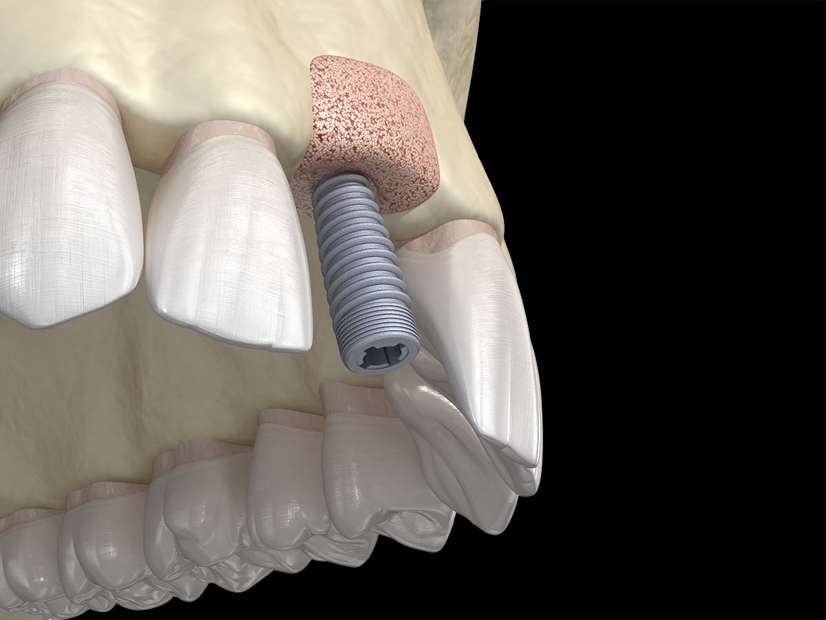 bone graft for dental implants