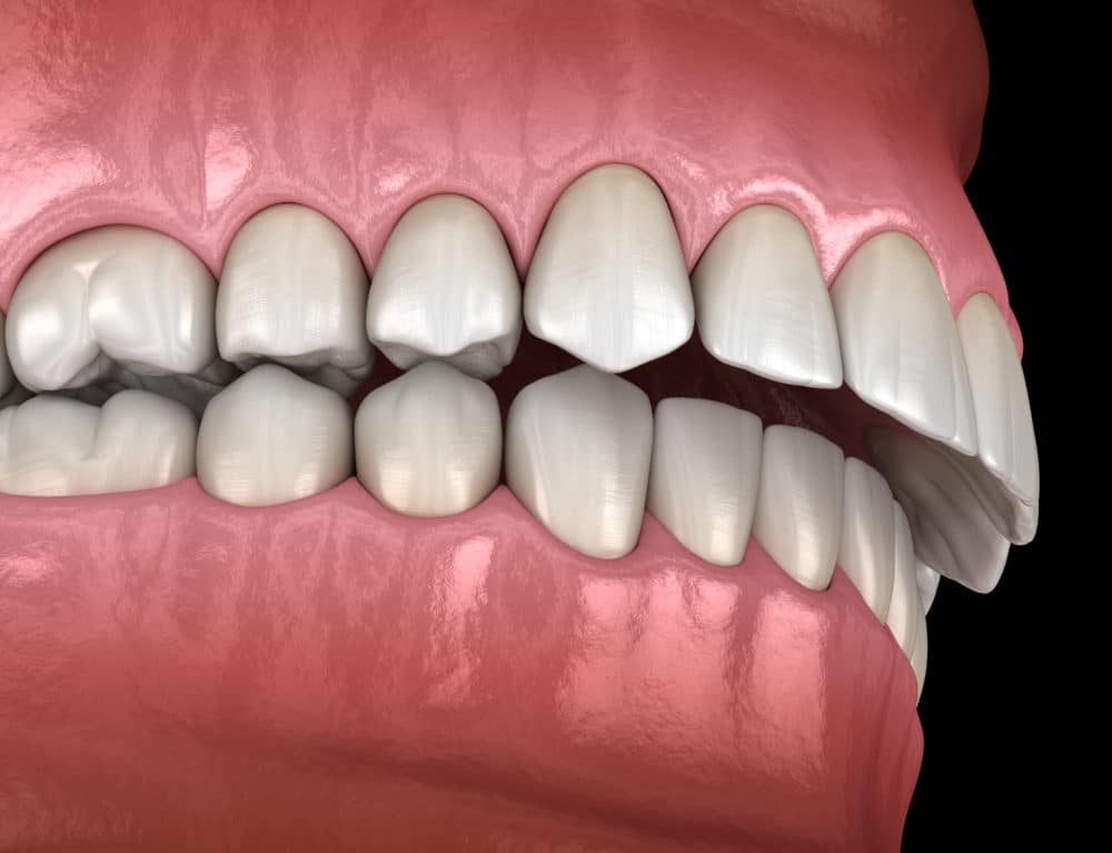 overbite correction