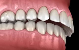overbite correction