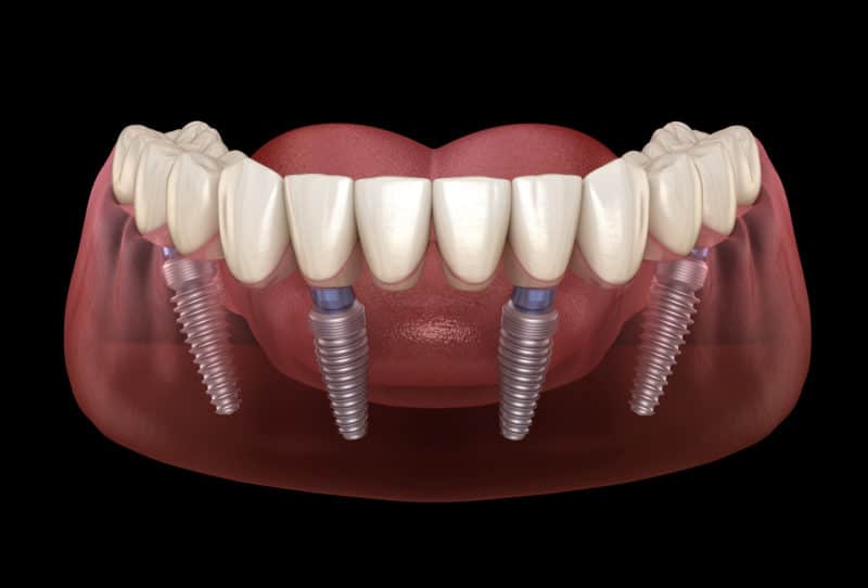 all on 4 dental implants