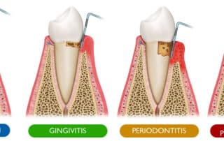 gum disease stages