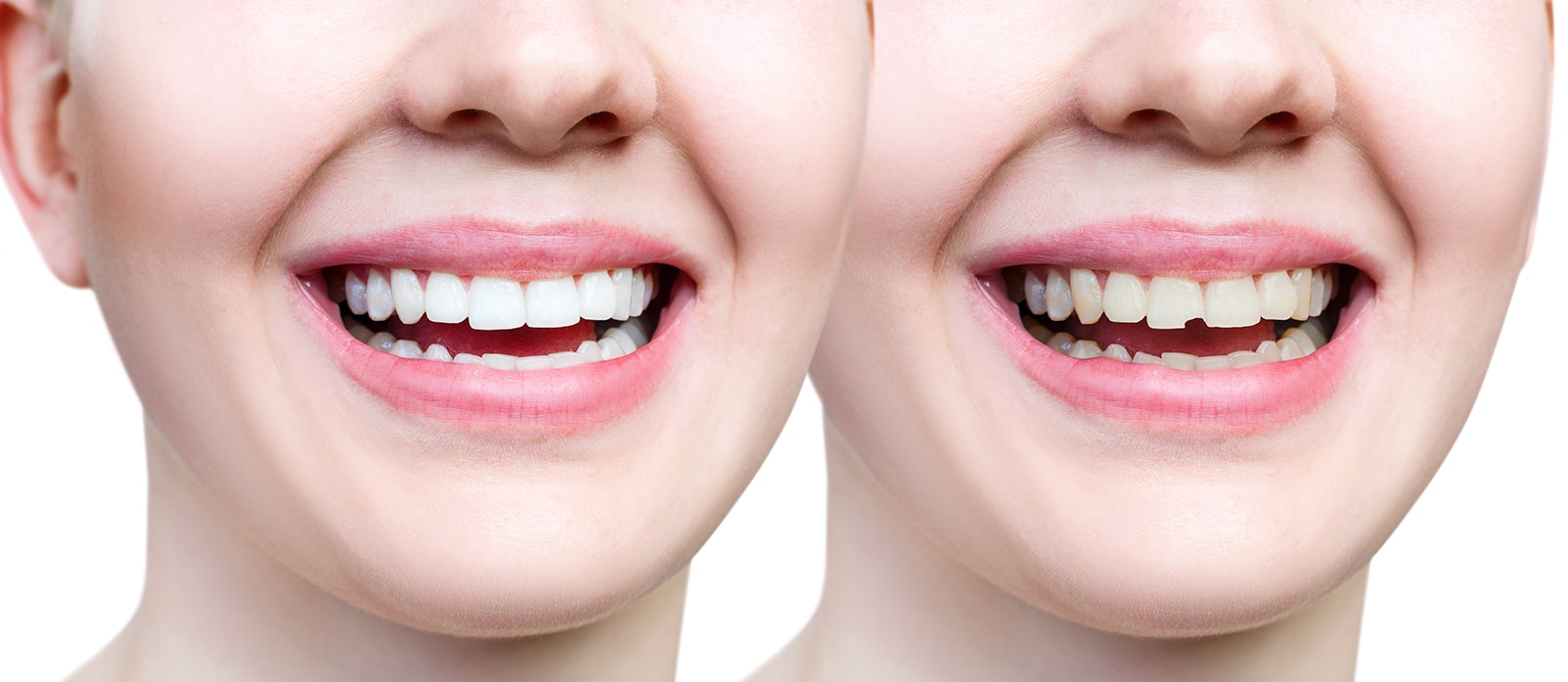 Understanding Broken Teeth Repair Cost in India