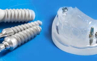Titanium Dental Implants