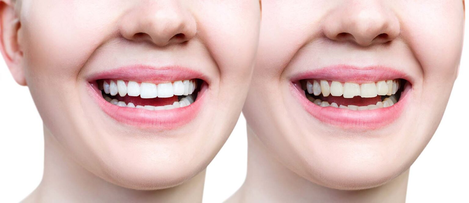 Benefits of Dental Bonding You Didn't Know