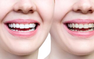 dental bondig