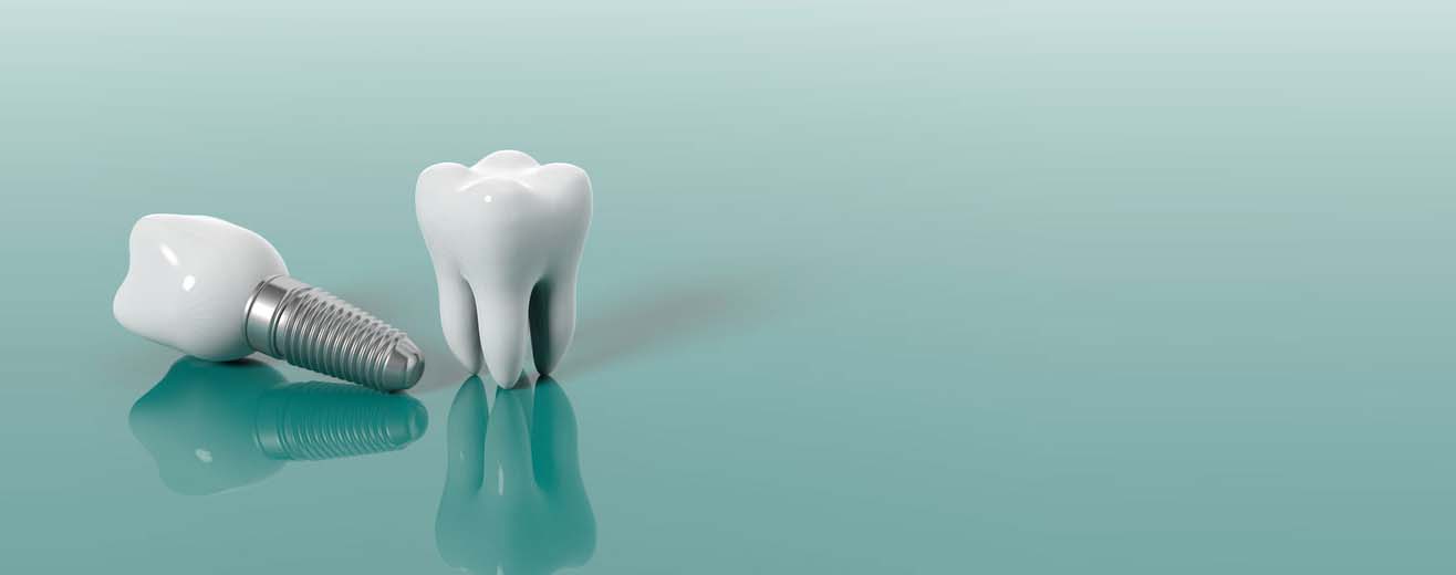 How much to pay for a Tooth Implant