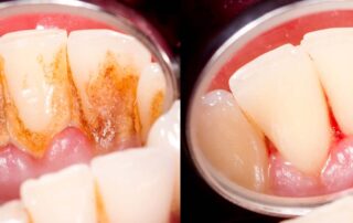 Removing and Controlling Dental Plaque