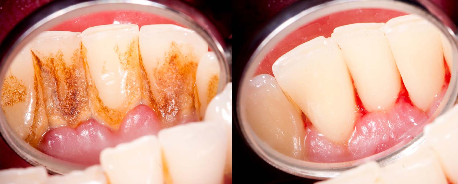 Removing and Controlling Dental Plaque