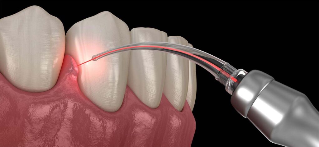 Gum Disease Treatment Guide