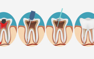 root canal infographic
