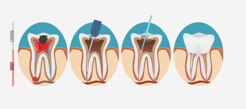 root canal infographic