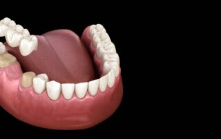 dental bridge