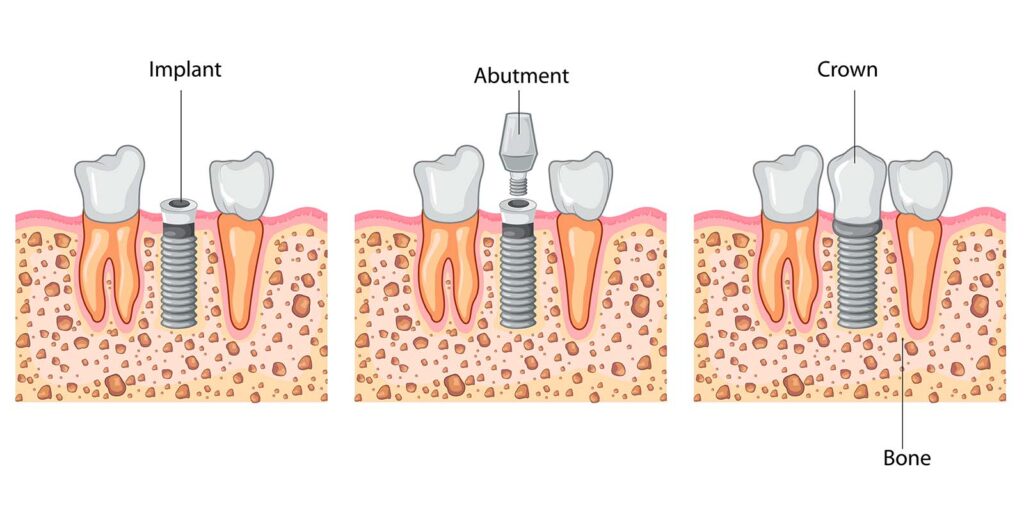 Abutment for Dental Implant
