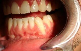 Gum Disease