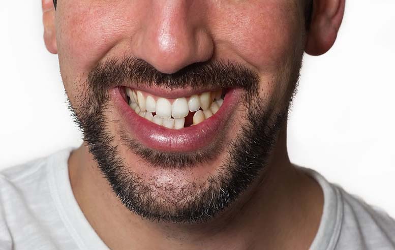 man with missing front teeth