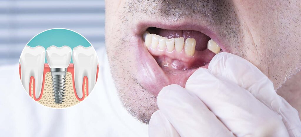 Single Tooth Dental Implants Los Angeles, CA