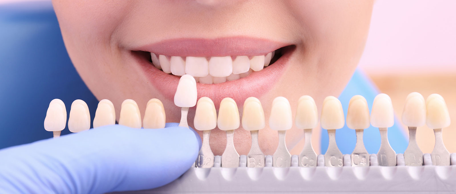 Composite Veneers Los Angeles, Treatment and Cost