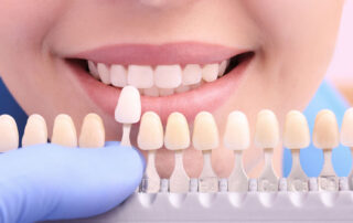 Composite Veneers Los Angeles, Treatment and Cost