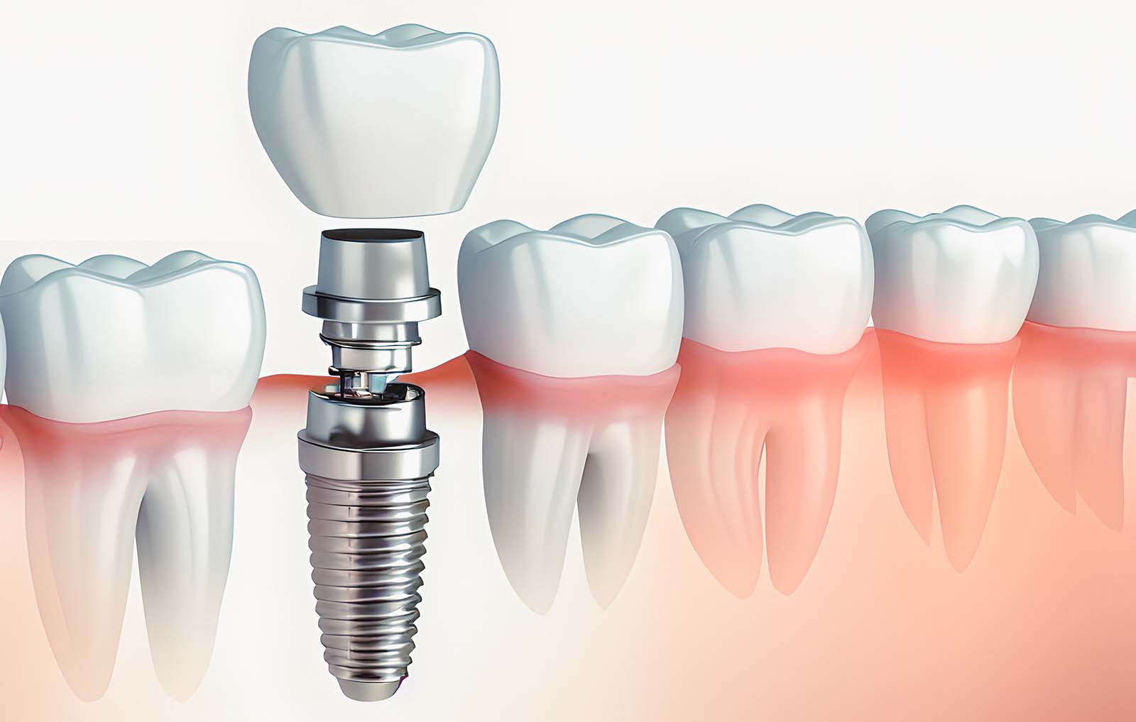 dental implants picture