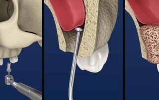 SINUS LIFT SURGERY