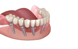 full mouth dental implants