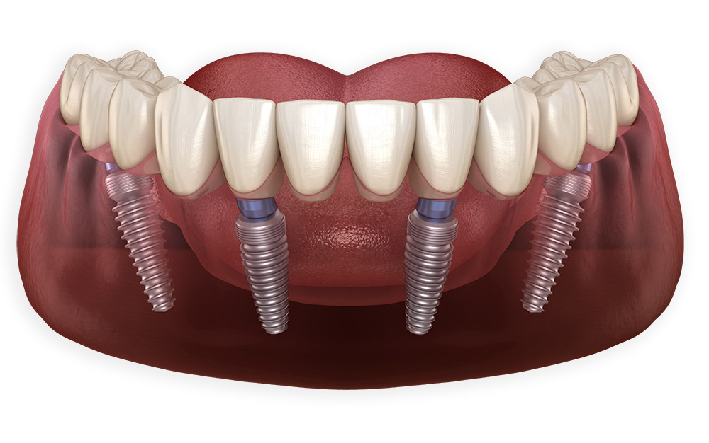 all on 4 dental implants los angeles