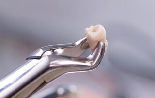 tooth extraction