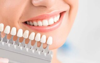 Veneers