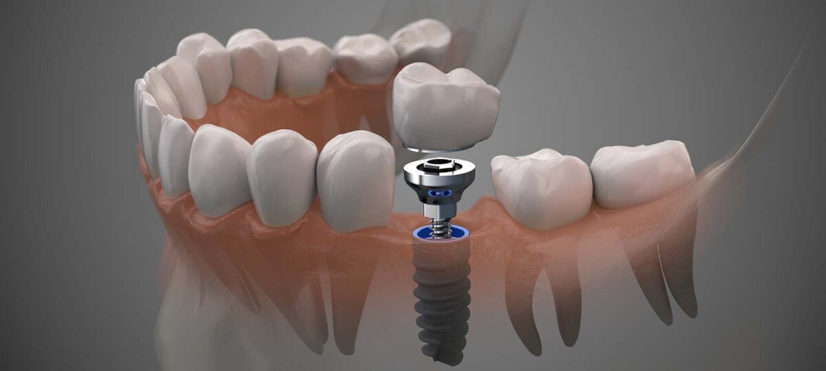How to pay for dental implants without insurance