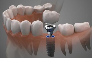 dental implants van nuys