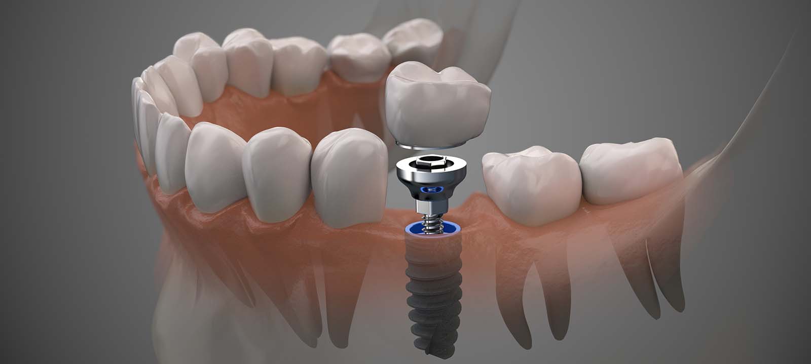 dental implants van nuys