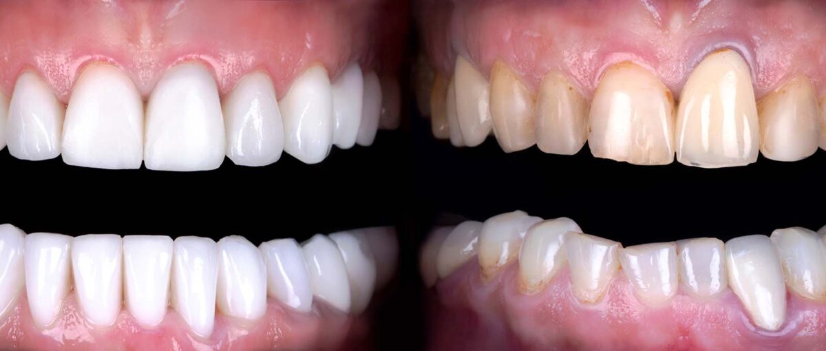 When Porcelain Veneers Go Wrong Understanding and Solutions