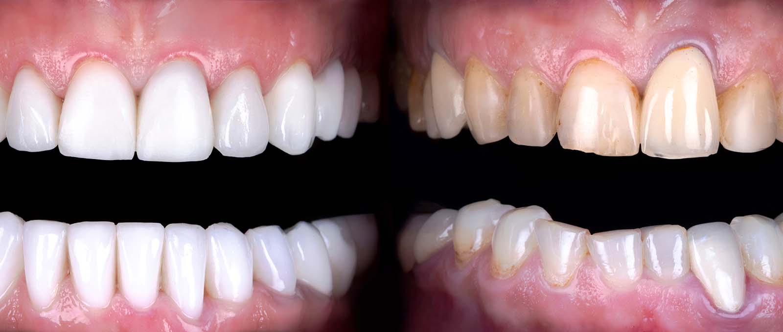Veneers Pros and Cons