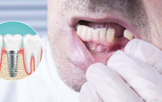dental implants picture