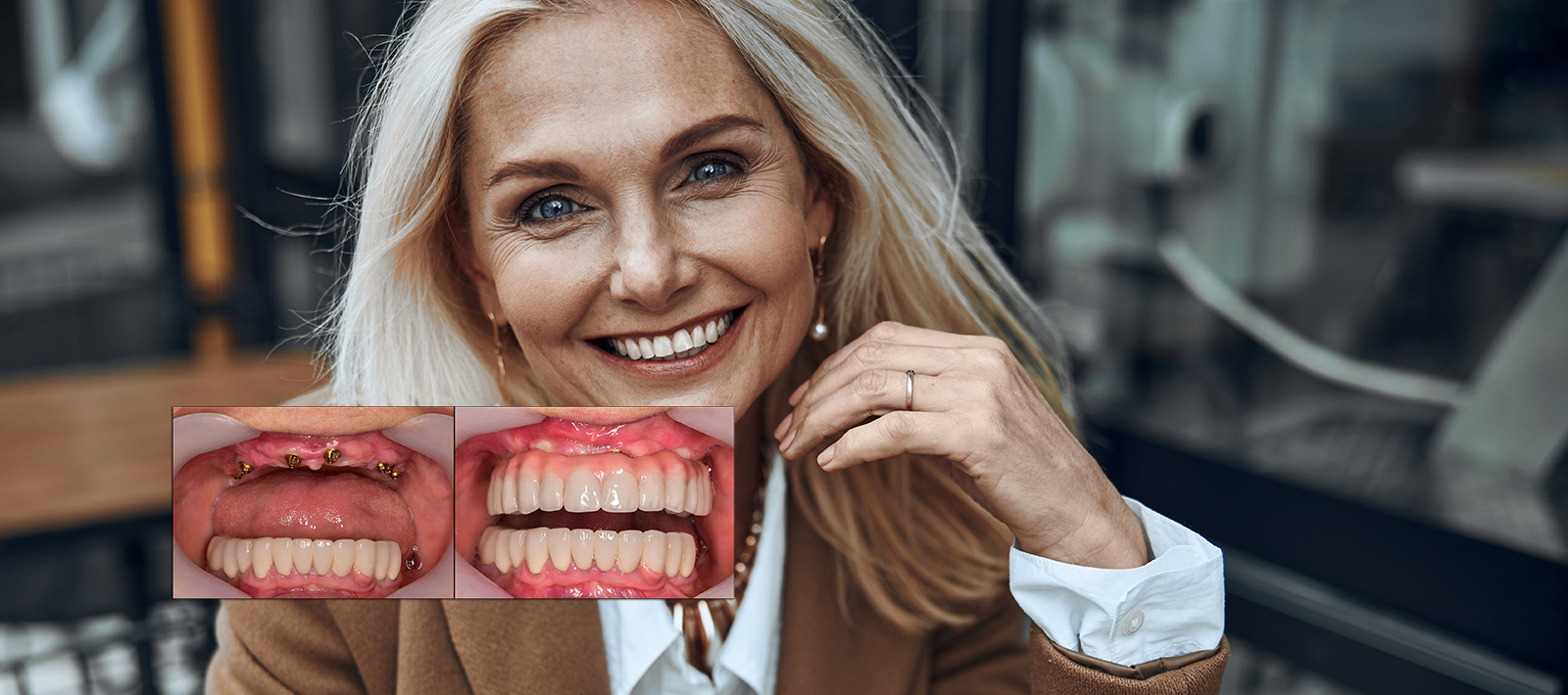 full mouth dental implant usa