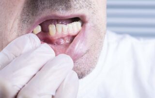 need dental implants
